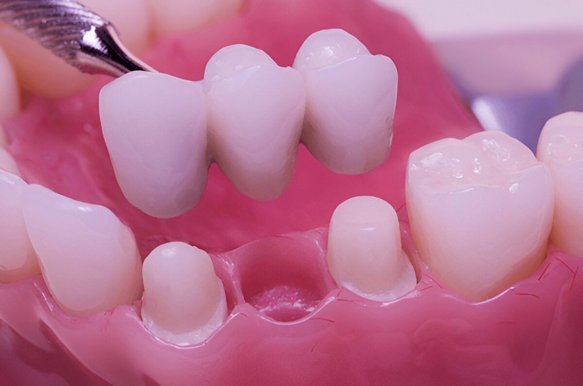 dental bridges near you