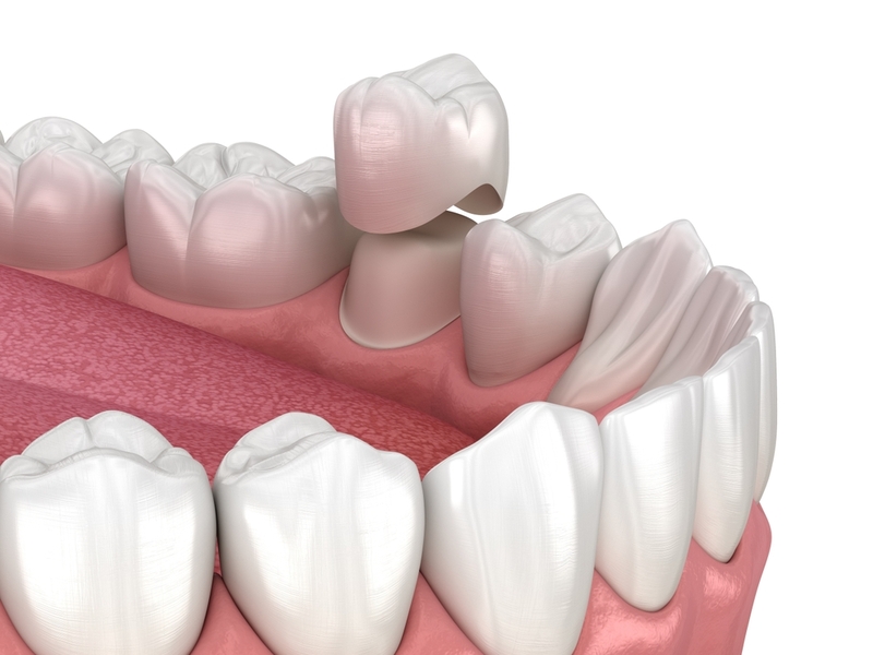 signs you might need a dental crown