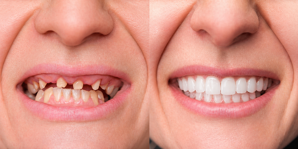 What Is Full Mouth Reconstruction and Do You Really Need It?